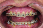 Fig 7. Mid-course orthodontic treatment.