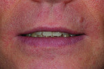 Fig 13. Lips at rest with wax-up.