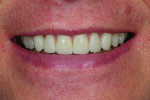 Fig 14. Smile after treatment completed.