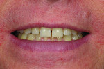 Fig 10. Retracted view after orthodontic treatment.