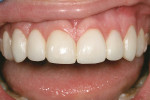 Figure 14  The finished restorations immediately after cementation.
