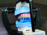 Fig 10. Teeth transferred to titanium substructure.
