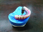 Fig 11. Screw access holes drilled into denture teeth.