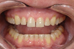 Fig 6. The patient is shown post-orthodontic treatment, final approval given by all three dental professionals, and only then were the brackets removed.