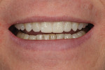 Fig 8. The resin remained in the mouth so the patient could evaluate the proposed finished result.