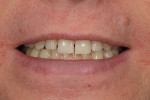Fig 5. The patient is shown post-orthodontic treatment, final approval given by all three dental professionals, and only then were the brackets removed.