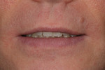 Fig 9. Photographs were taken of the smile at rest and sent with the case to the laboratory.