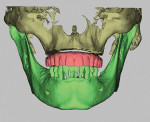 Fig 2. The digital information is processed and composed symphonically to create an accurate virtual dental patient, with both hard and soft tissues, to start the multidisciplinary workup with the restoring dentist, the oral-maxillofacial surgeon, and the dental technician at the GTM stage of the treatment planning session.