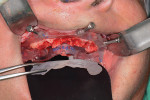 Fig 8. The removable clear mock-up teeth
are removed, exposing the deformed alveolar bone that was pre-planned for removal (osteotomy) to accommodate the dental implants and final prosthetics for strength and esthetics.