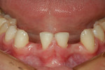 Fig 1. Preoperative labial view of a post-orthodontic patient who was congenitally missing both mandibular lateral incisors.