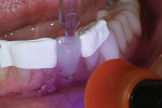 Fig 5. The labial increment of composite inside
the Uveneer template shown being light-cured to place.