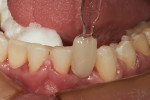 Fig 2. After placement of the fiber reinforcement on the lingual surfaces of teeth Nos. 22 through 27 (the fiber would also serve as a fixed lingual retainer), composite was added to the fibers in the edentulous area to construct a pontic replacing all but the last 1 mm to 2 mm of the labial surface (enamel). Uveneer was used to complete the esthetic placement of the final layer of composite to the labial surface of the direct composite bridge.