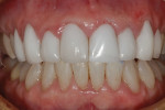 Fig 8. Labial view of the completed “composite temporary” repairing the fractured porcelain veneer.