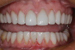 Fig 6. Uveneer composite temporary restoration shown upon completion. The patient would be reappointed to have a new porcelain veneer made when the appropriate time for the procedure could be scheduled.
