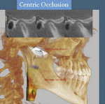 Fig 6. Top image shows a lateral view of the right condyle in CO (note distraction). Bottom image shows the reconstructed airway volume and MCSA in CO. The MCSA of this patient’s airway, in an upright and awake position in CO, was 162.4 mm2.