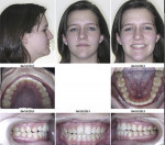 Fig 7. Facial and intraoral photographs in a manipulated CR position to first tooth contact (maxillary right second molar area). The mandible has repositioned with the right TMJ “seated into the fossa” creating a malocclusion with a buccal cross-bite, midline shift, and facial asymmetry. Note the difference in the condylar position and the airway MCSA between CR (99.9 mm2) and CO (164.4 mm2). The airway MCSA in CR was 38.49% smaller than the MCSA in CO.