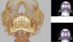 Fig 2 and Fig 3. The 3D CBCT scan in CO utilizing a stereophotogrammetry system with 1.5-millisecond capture with 1-minute processing time and a resolution of 0.1 mm across the whole facial surface.