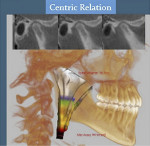 Fig 8. Top image shows a lateral view of the right condyle in CR seated position. Bottom image shows the reconstructed airway volume and MCSA in CR. The MCSA in CR was 99.9 mm2.