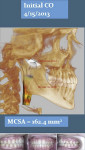 Fig 12 through Fig 14. Comparison of initial CBCT scan in CO (4/15/2013), initial CBCT scan in CR (4/15/2013), and final records after debanding (1/22/2014). The airway changes can be visualized from the rendered views. Initial CO = 162.4 mm2, initial CR = 99.9 mm2, and final CO-CR = 150.1 mm2. The final CBCT scan was taken the day of debanding, so some postsurgical edema was still present.