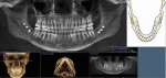 Fig 15. Final postsurgical reconstructed panoramic for CBCT (1/22/2014).