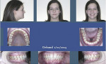 Fig 11. Facial and intraoral photographs on the day of debanding (1/22/2014). Fixed upper and lower 3-3 retainers were placed along with upper and lower clear retainers. Note the occlusion was back to her original CO position but now with the condyles reseated into the fossa.