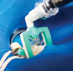 Figure 4  Load syringe with the Icon-Infiltrant, place perforated side facing the lesion, and slowly extrude the first application onto the tooth. Allow to sit for 3 minutes for deep penetration into the lesion. Remove excess material with dental flo