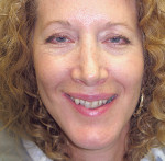 Figure 2  Preoperative photographs. The patient felt self-conscious about her smile and wanted them straighter and whiter. Note the anterior crowding and very prominent maxillary right canine.