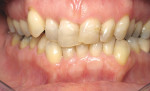 Figure 3  Preoperative retracted view. Note the prominent buccal position of tooth No. 6, the irregular gingival lines, anterior crowding and overlap, and how the premolars are obscured in the background.