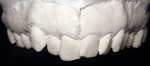 Figure 6  From the initial maxillary model, the laboratory was able to create the diagnostic esthetic wax-up.
