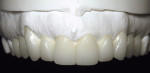 Figure 7  From the initial maxillary model, the laboratory was able to create the diagnostic esthetic wax-up.