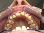 Figure 9: Both the buccal and incisal preparation guides (fashioned from the diagnostic wax-up) were used to verify proper reduction.