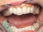 Figure 12  The periodontal stint fabricated by the laboratory to help achieve what was created in the wax-up was used to guide the gingival recontouring performed by the electrosurge to generate a more symmetrically balanced smile.