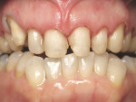 Figure 13  The periodontal stint fabricated by the laboratory to help achieve what was created in the wax-up was used to guide the gingival recontouring performed by the electrosurge to generate a more symmetrically balanced smile.