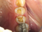 Figure 17  The old amalgam fillings were removed from teeth Nos. 12 and 13, in preparation for tooth-colored bonded restorations that will eliminate the gray shadowing through the veneers.