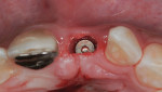 Fig 3. Implant placed <2 mm bone facial of implant placed.