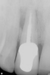 Fig 11. Preoperative periapical radiography.