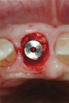 Fig 12. Implant placed, allogenic graft placed by minimally invasive protocols.
