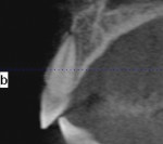 Fig 15. Case 2, post-traumatic computed tomography scan serial view right central incisor.