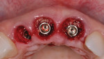 Fig 16. Case 2, immediate implant placement Nos. 7, 8, and 9 with allogenic bone graft placed into facial plate defects and peri-implant defects.