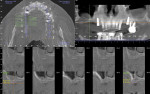 Fig 20. Pretreatment CT scan, case 3, full-mouth failing dentition.