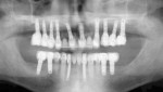 Fig 21. Immediate postoperative panoramic view of full-mouth immediate implant placement and loading in extraction, edentulous and sinus grafted sites.