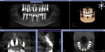 Fig 23. 7-year post-treatment CT scan views of full-mouth immediate implant placement loading in extraction, edentulous and sinus-grafted sites.