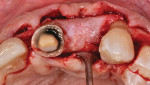 Fig 9. Type 4 bone replacement procedure.