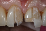 Fig 1. Example of excessive removal of tooth structure due to inability to discriminate between crown, resin cement, and tooth.