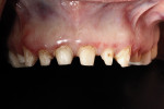 Fig 6. Cement remained on natural tooth.