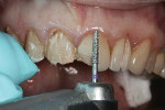 Fig 7. Restoration thickness can be reduced with a bur.