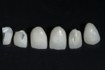 Fig 4. Most crowns were fully intact after use of laser and chisel.