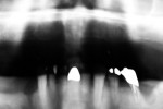 Figure 1  Panoramic radiograph and occlusal view of edentulous arch indicates compromised vertical and horizontal bone.