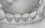 Fig 5. Attrition on the facial of the lower incisors.