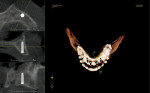 Figure 3  Diagnosis of edentulous maxilla and virtual placement of four dental implants in the maxillary arch using the Keystone Easyguide CT scanning software.